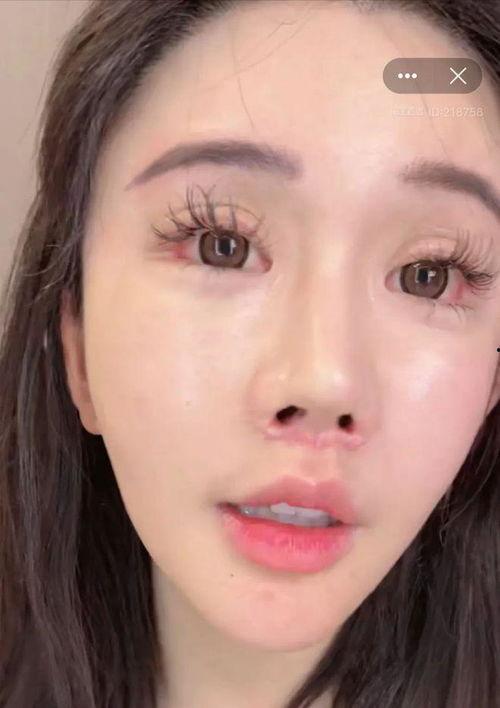 整形失败视频,揭秘手术风险与术后悲剧