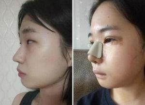 整容视频过程,从术前准备到术后恢复