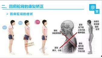 如何纠正驼背视频,跟随专业视频，轻松改善体态
